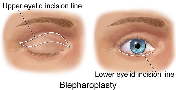 Eyelid Surgery Seattle - Blepharoplasty in Seattle