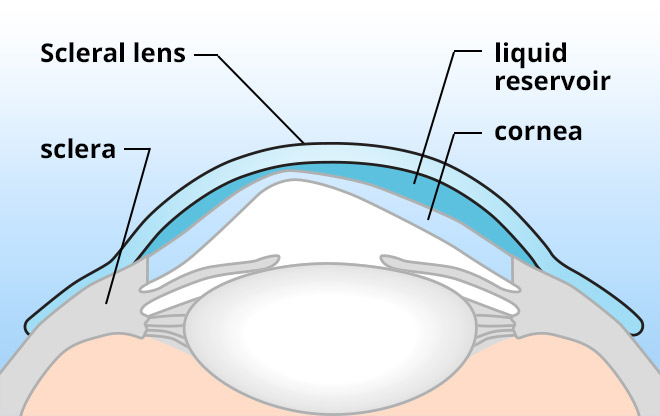 medically-necessary-contact-lenses-eye-associates-northwest