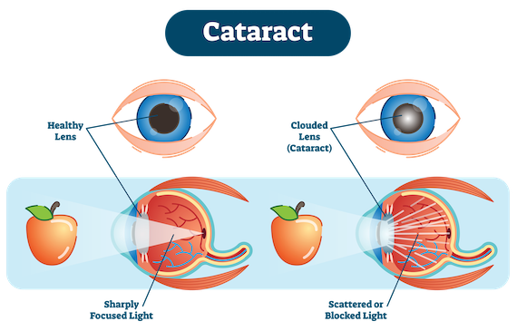 Cataract Surgery