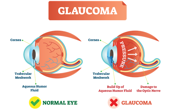 Glaucoma