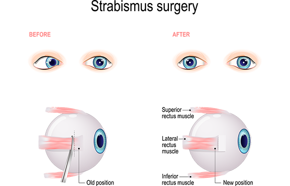 Adult Strabismus