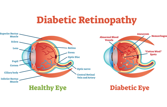 Diabetic Eye Disease