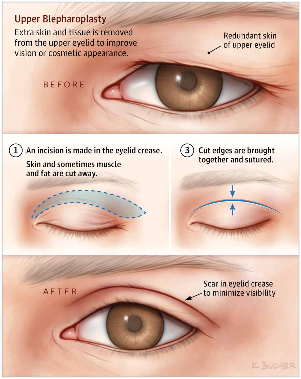 UL Blepharoplasty